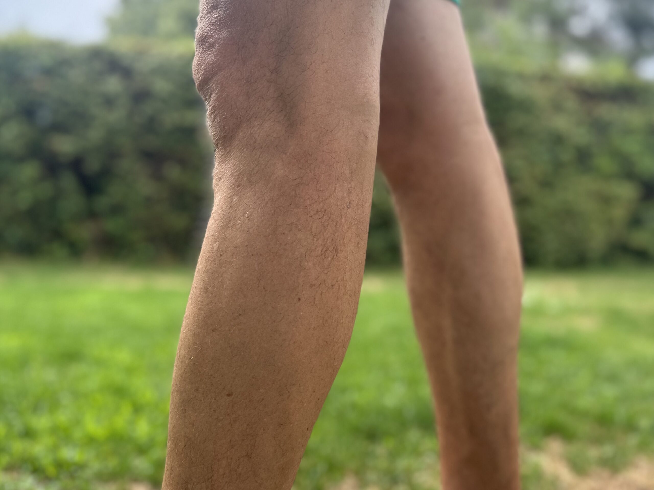 Bild von einer Wade mit Muskelfaserriss: Akuter Schmerz nach dem Sport? Ein Muskelfaserriss kann ernst sein. MRT in Landshut & Dingolfing, Ultraschall in Landshut – für schnelle Klarheit & Heilung. Im Hintergrund grüne Wiese und Hecke